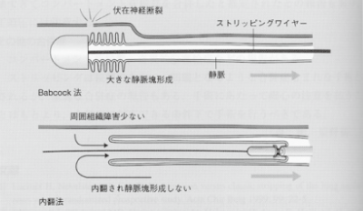 ストリッピング手術